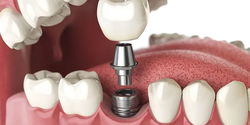 diş implantı