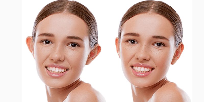 kepçe kulak ameliyatı