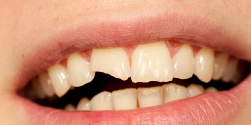 kırık diş tedavisi