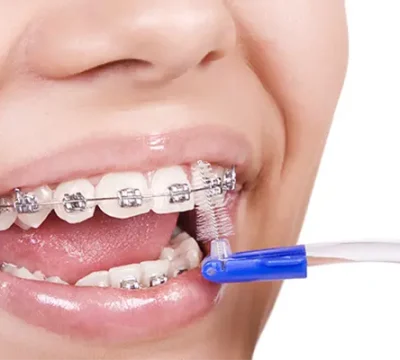 Orthodontics-in-turkey