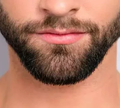 beard-transplant-turkey