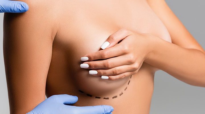 breast-reduction
