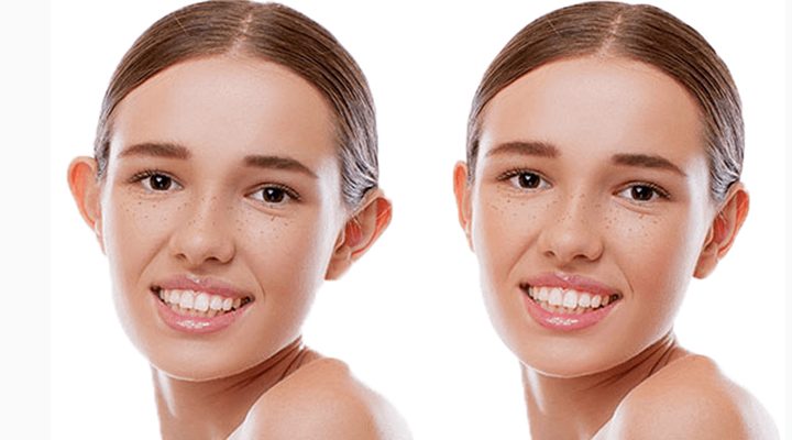 otoplasty