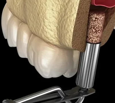 tmj-splint-in-turkey