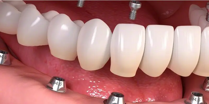 zirconium-crown-in-turkey