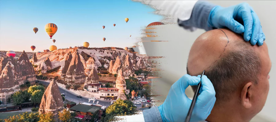 hair-transplant-in-cappadocia