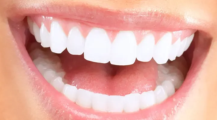 hollywood-smile-in-turkey