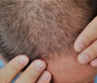 sac-ekimi-sonrası-sac-kusmesi