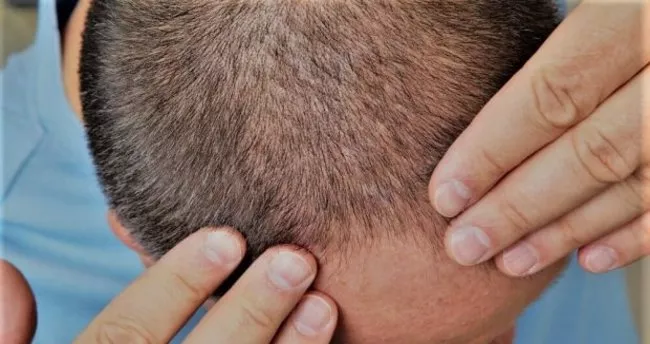 sac-ekimi-sonrası-sac-kusmesi