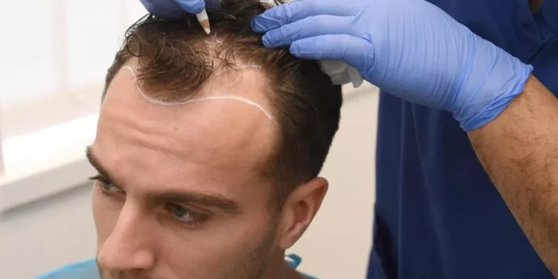 saç kesmeden saç ekimi