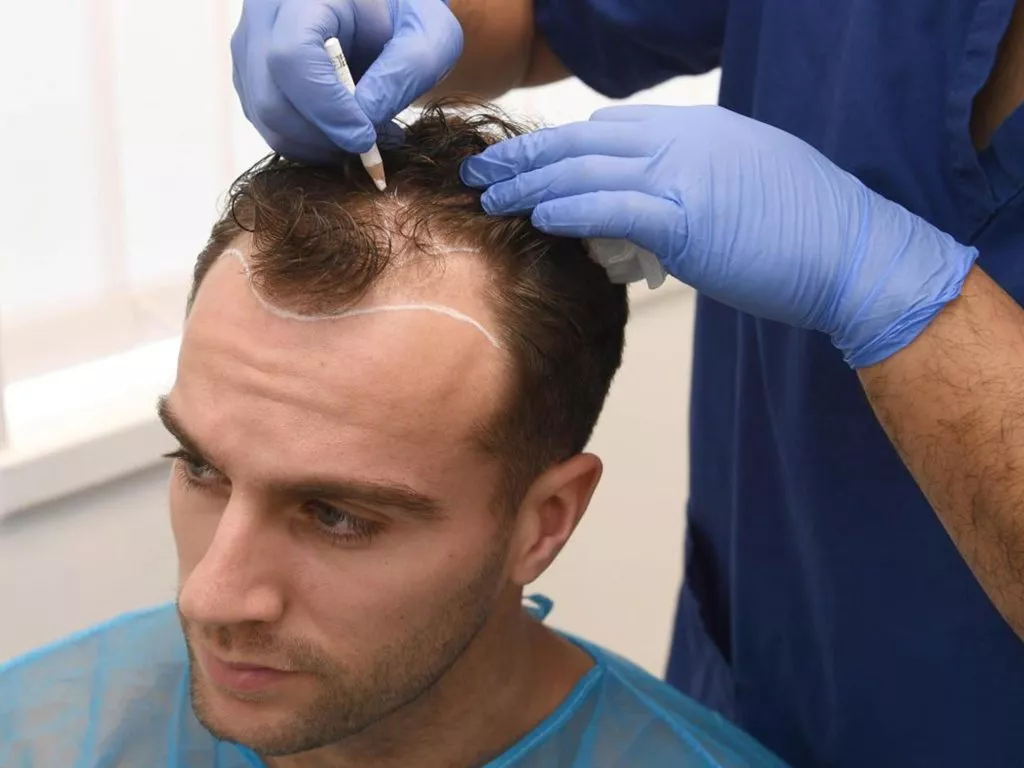 sac-kesmeden-sac-ekimi