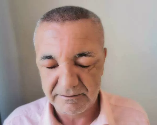 sac-ekimi-sonrasi-yuz-sismesi