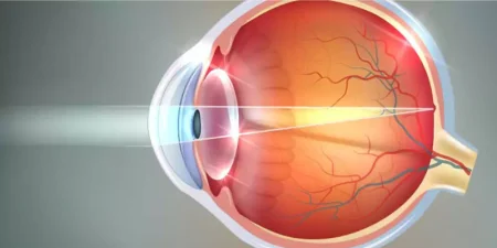 Astigmatism