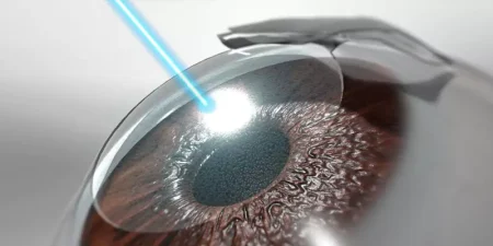 LASIK Eye Surgery