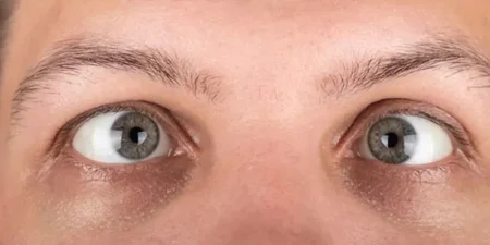 Strabismus Surgery