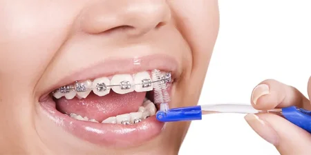 Orthodontics-in-turkey