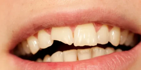 broken-tooth-treatment