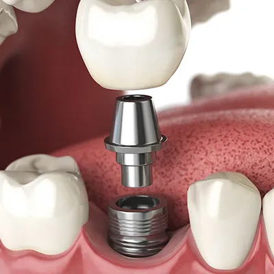 dental-implants-in-turkey