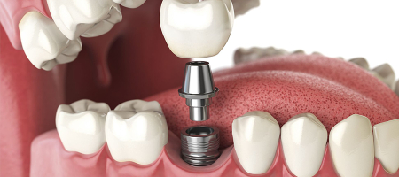 dental-implants-in-turkey