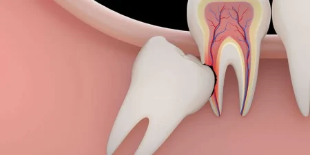 dental-lesion-in-turkey