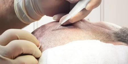 dhi-hair-transplant