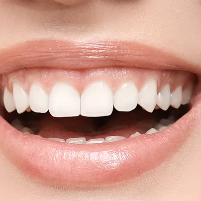 gummysmile