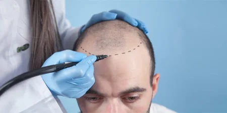 hair-transplant-in-turkey