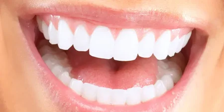 hollywood-smile-in-turkey