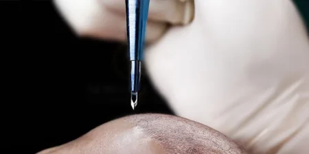 sapphire-hair-transplant