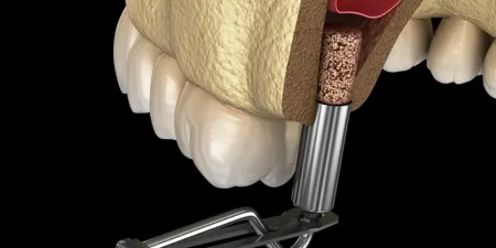 tmj-splint-in-turkey