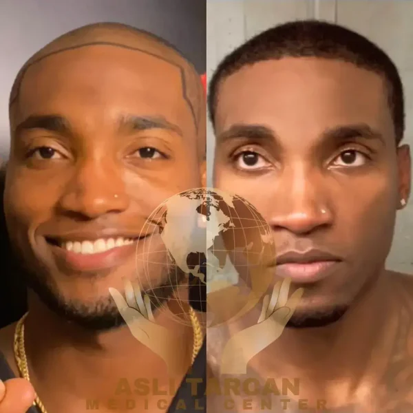 afro hair transplant in turkey before after