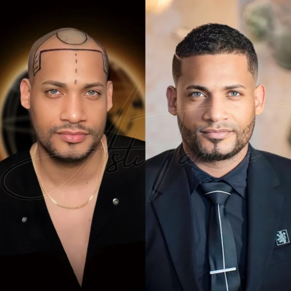 Hairline Restoration