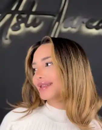 Lip Filler Turkey Results Asli Tarcan