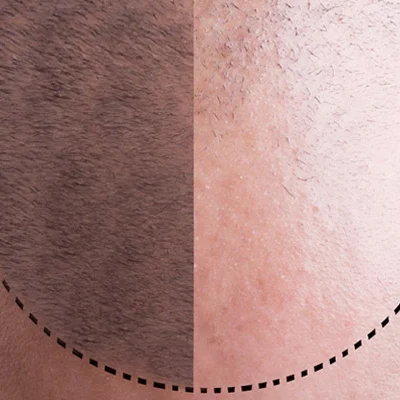 hair-implant-istanbul