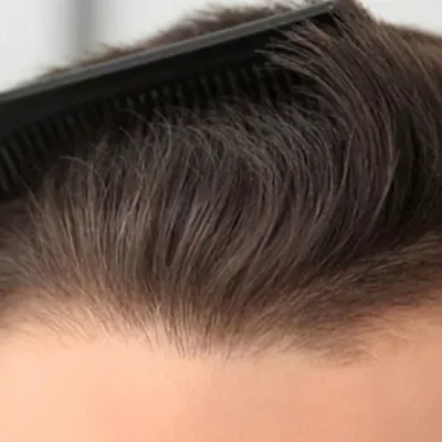 hair-surgery-istanbul