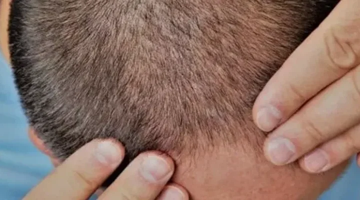 saç ekimi sonrası saç küsmesii