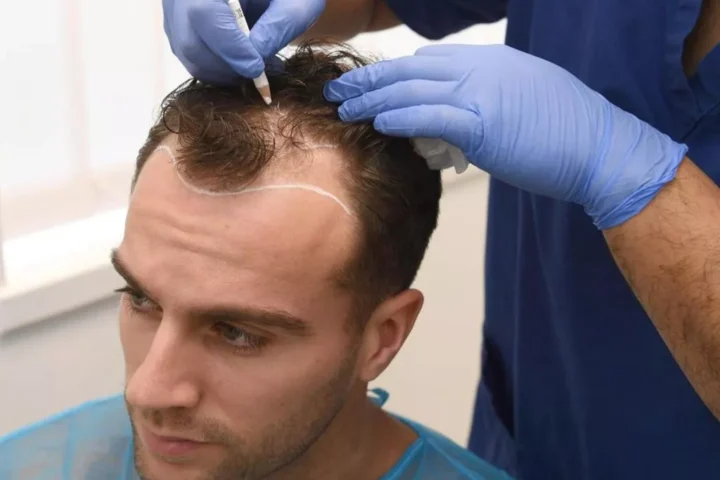 sac-kesmeden-sac-ekimi