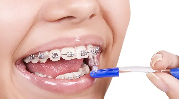 Orthodontics-in-turkey