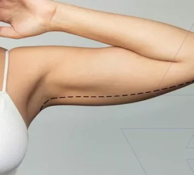 arm-lift-800x400-69a6d212965fe