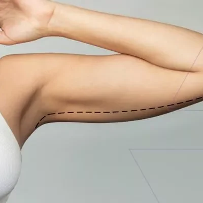 arm-lift-800x400-69a6d212965fe