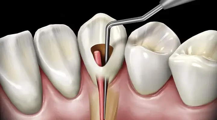 canal-treatment-in-turkey