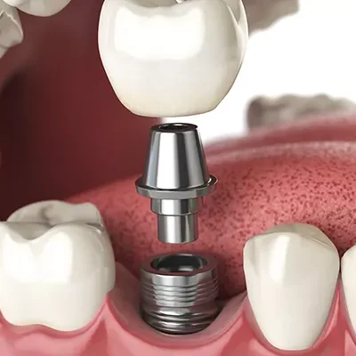 dental-implants-in-turkey-800x400-69a696e92252c