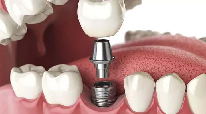 dental-implants-in-turkey-800x400-69a696e92252c