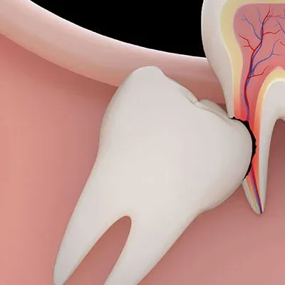 dental-lesion-in-turkey