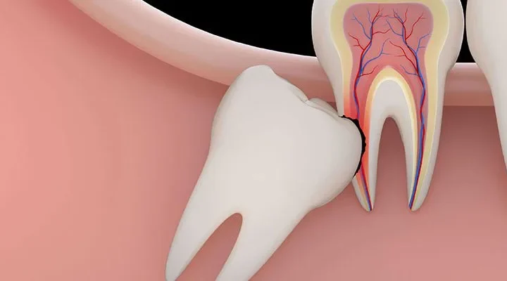 dental-lesion-in-turkey