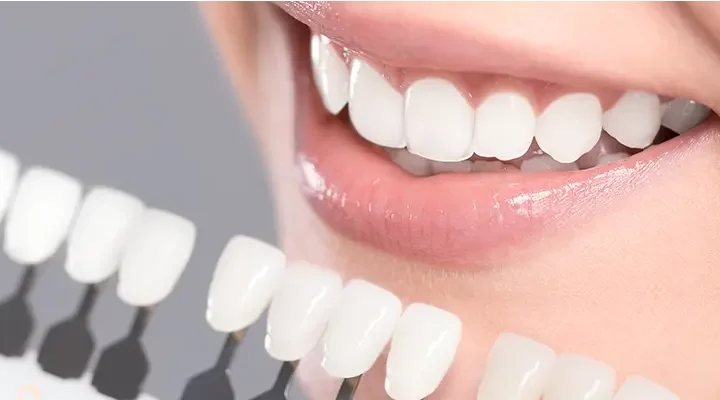 laminate-veneer-in-turkey