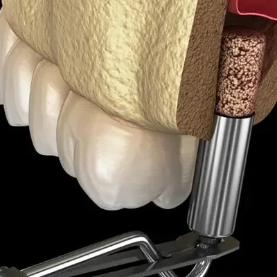 tjm-splint-in-turkey