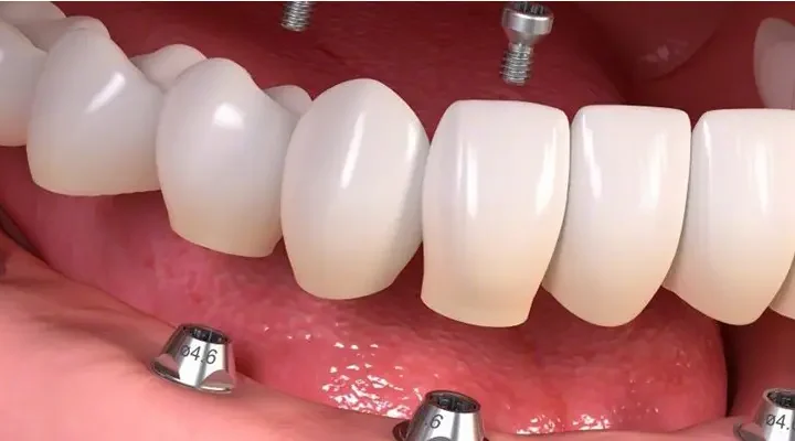 zirconium-crown-in-turkey
