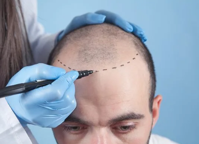 Hair Transplant in Istanbul
