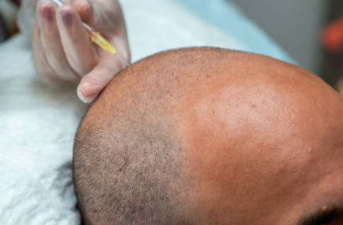dhi hair transplant 